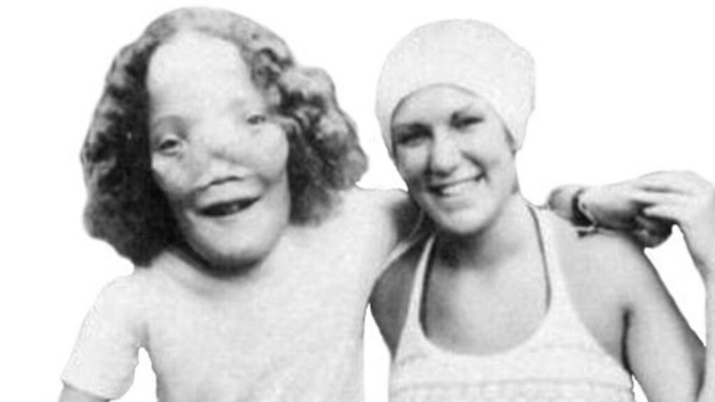 Rocky Dennis – Chłopak, którego twarz przypominała lwią maskę. Historia, która pokonała medycynę i Hollywood